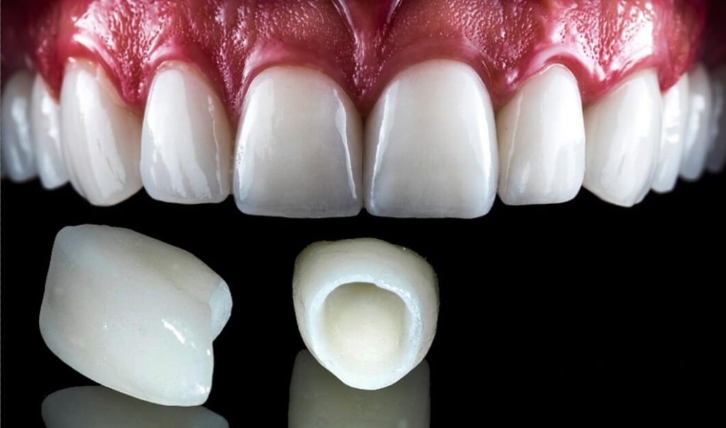 Emax Veneers